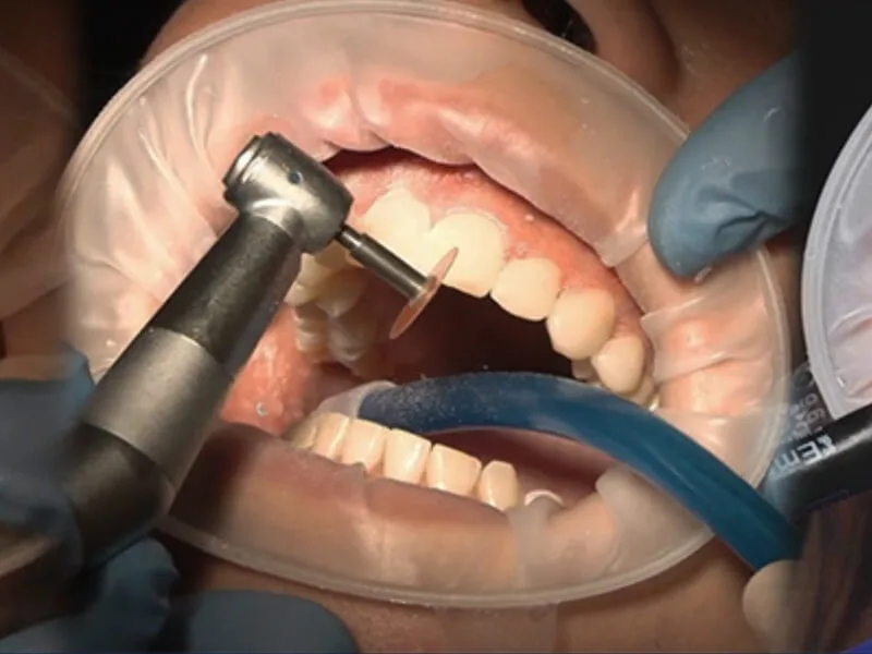 Master Estética Dental de Carillas IESO